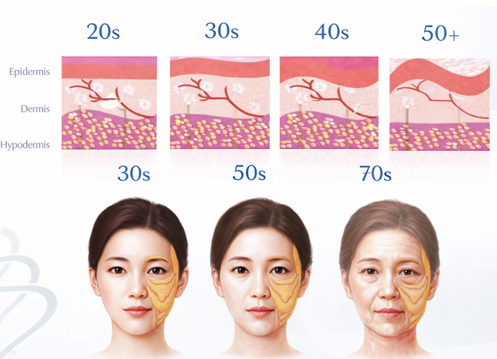 Collagen Loss Skin Aging Illustration Showing Wrinkles, Sagging, and Reduced Skin Elasticity